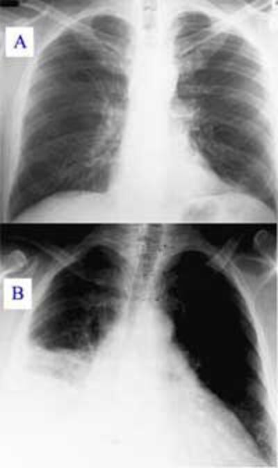PneumoniaViemphoi200.jpg