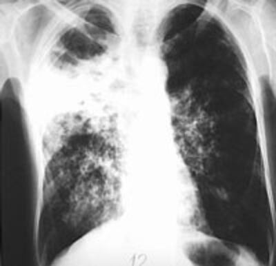 tuberculosis-200.jpg