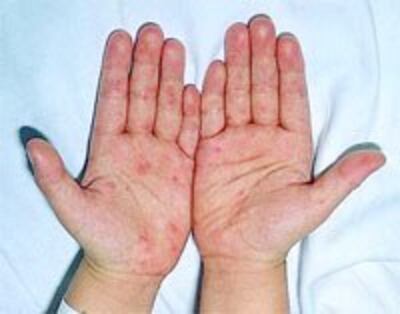HandFootMouth200.jpg