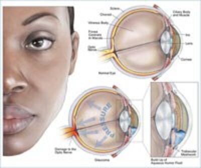GlucomaEye200.jpg