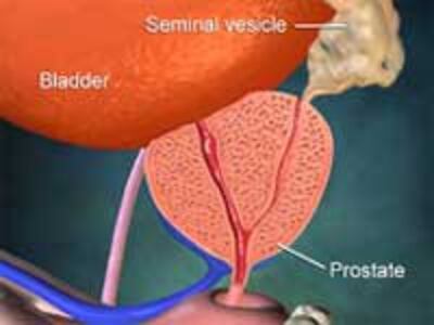 Prostate200.jpg
