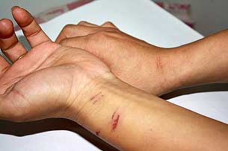 WangGang_bruise305