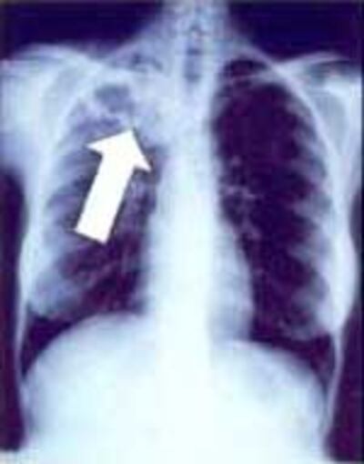 TuberculosisLaoPhoi150.jpg