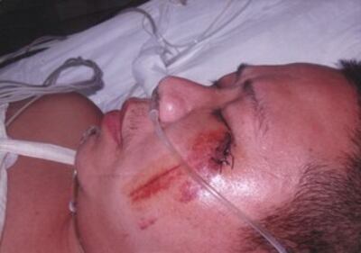 图片：土地维权村民代表宋卯生被砍伤的左眼睑（西安村民提供）