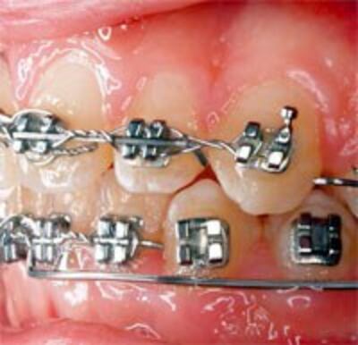 BracesNiengRang200.jpg