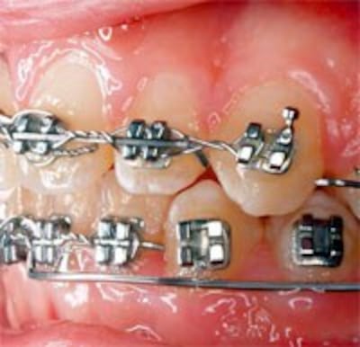 BracesNiengRang200.jpg