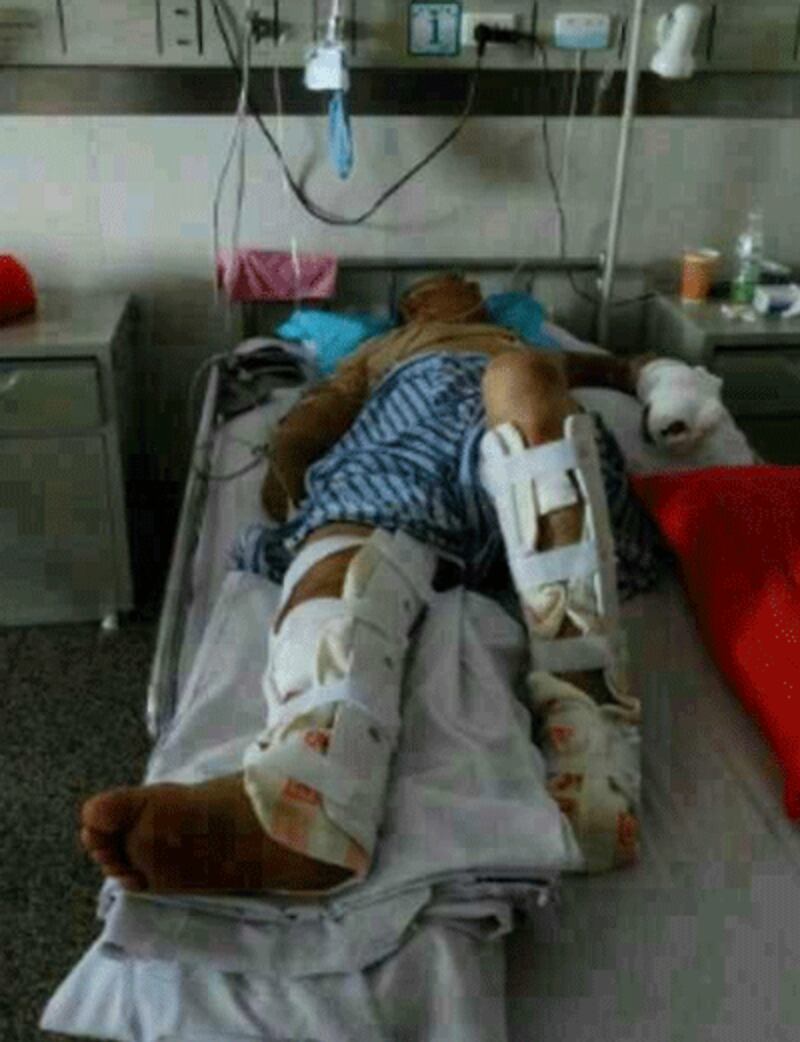 One of the Tibetans who suffered broken legs.