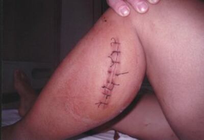 图片：被砍伤的左小腿（西安村民提供）