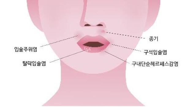 입 주변 뾰루지 [을지병원 제공]