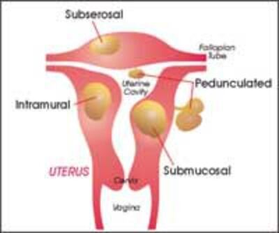 UterineFibroidsTuCung200.jpg