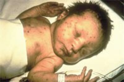 RubellaBaby200.jpg