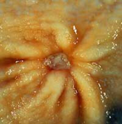 GastricUlcer200.jpg