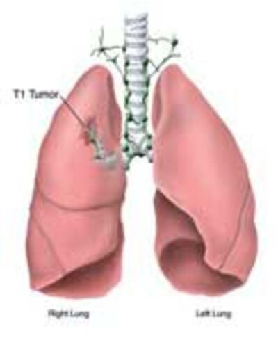 LungCancer150.jpg