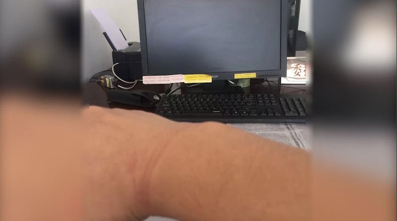 胡耀辉展示被广州辅警殴打的表面痕迹。(胡耀辉提供,拍摄日期不详)