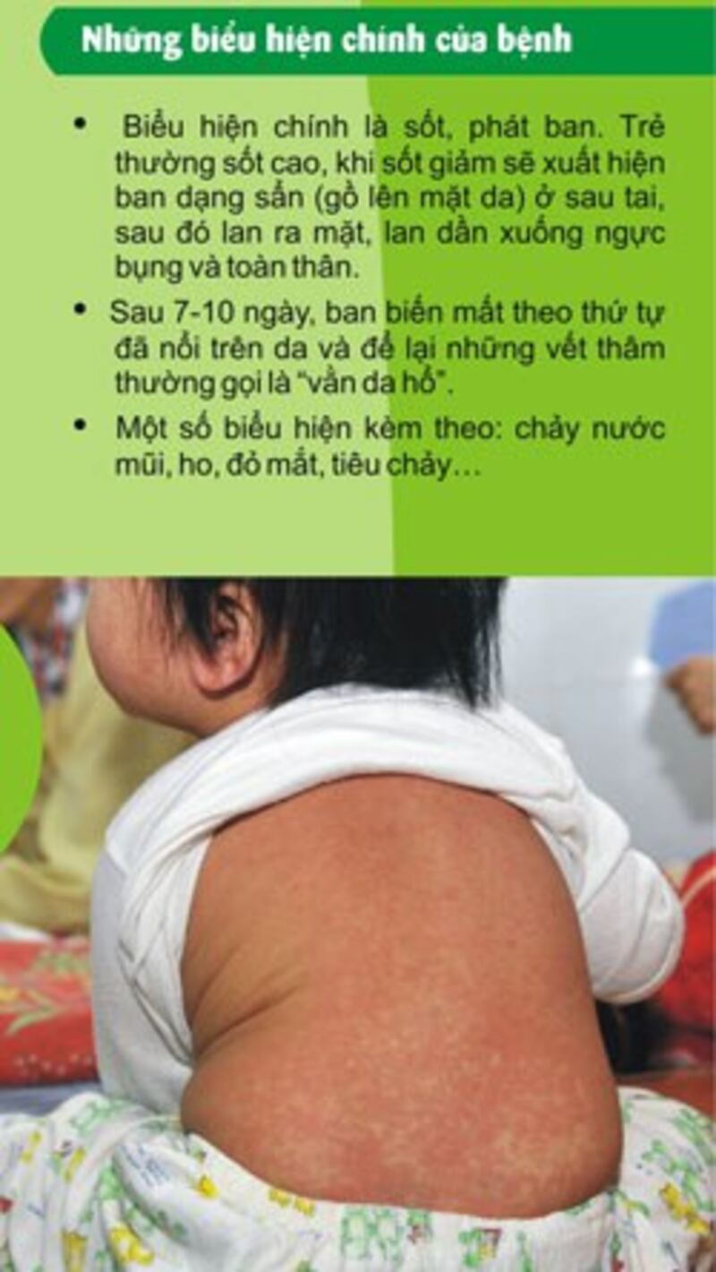 Biểu hiện của bệnh sởi