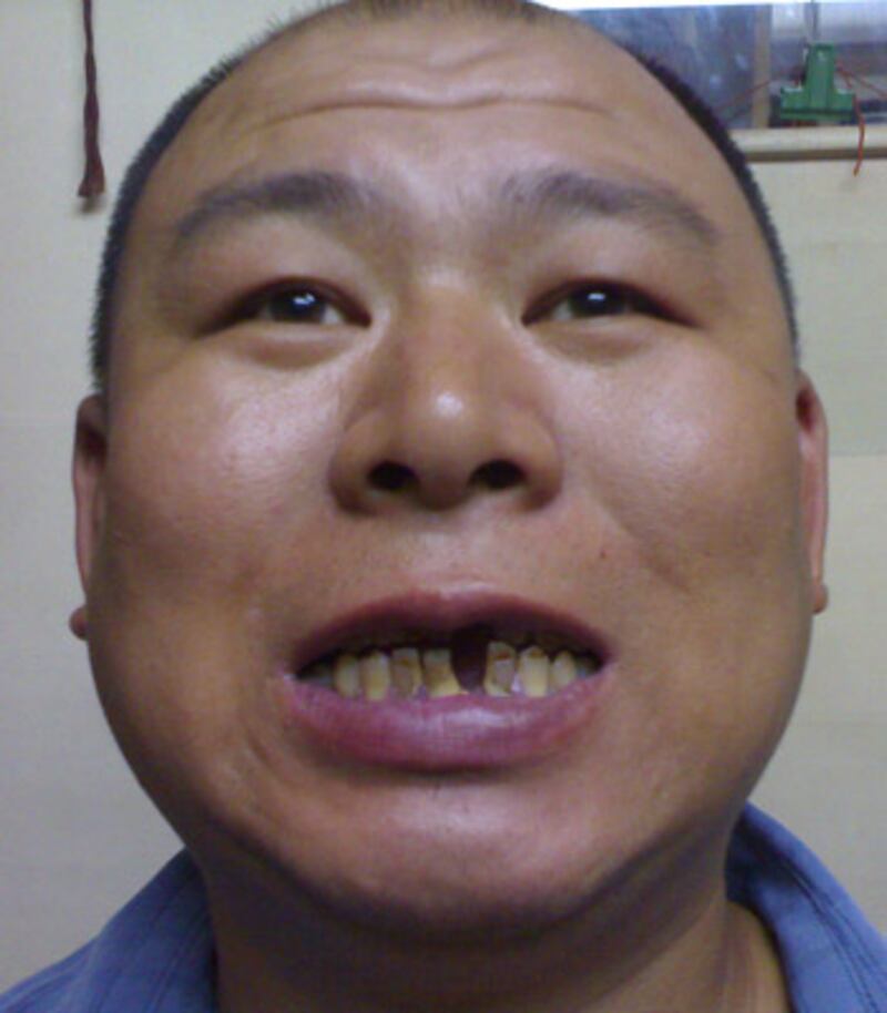 剛出獄的孫宏向親人展示被警察打斷的兩顆牙齒。(照片拍攝於2007年8月21日。孫立勇授權記者發表)