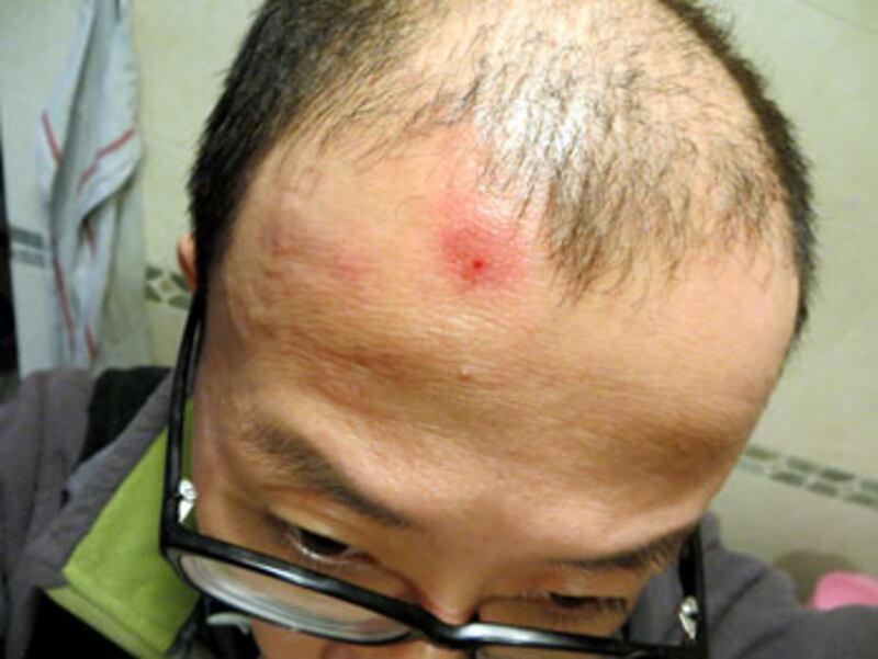 2013年3月14日,胡佳在被傳喚問話期間,被兩名國保毆打受傷。(胡佳提供)