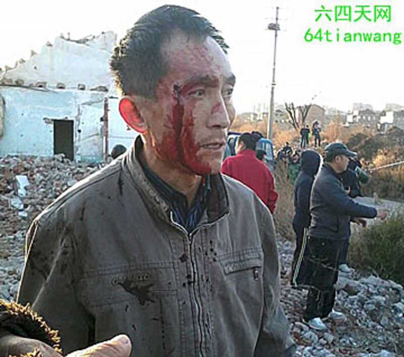 11月19日，青島市四方區政府出動300多人暴力強拆當地小水清溝村的村民住宅，遭到村民的反抗，一名村民的臉上被拆遷人員劃開了五公分長的口子，血流滿臉。(圖片由六四天網提供。)