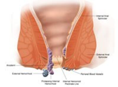 HaemorrhoidsBenhTri200.jpg