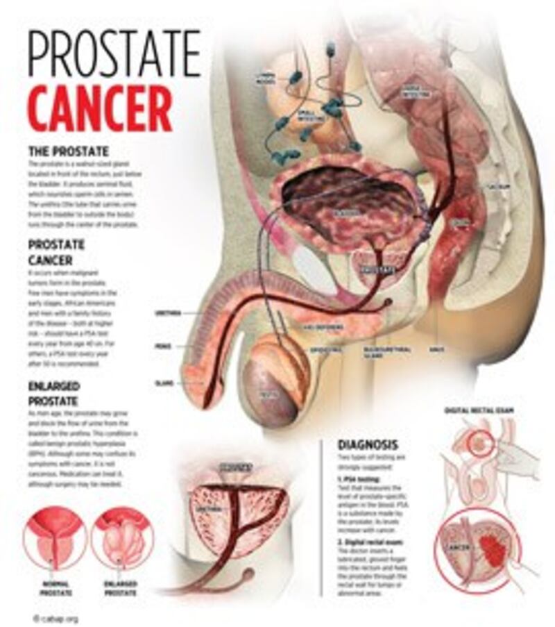 Prostate cancer - Ung thư tuyến tiền liệt. Ảnh minh họa (Courtesy cabap.org)