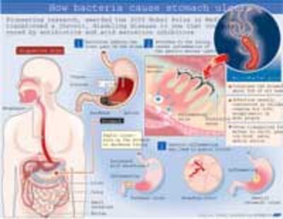 UlcerBacteria200.jpg