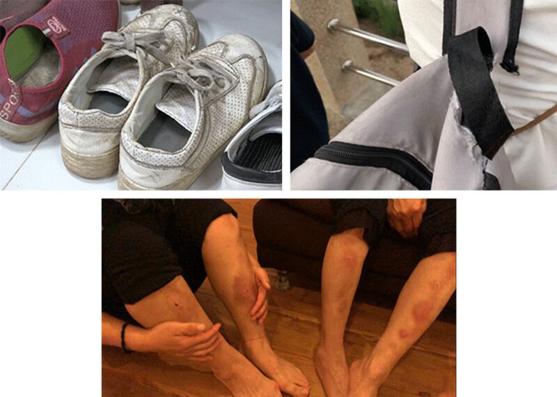 7개의 산을 넘는 과정에서 상처를 입은 다리. 두 달여 험난한 탈북 여정이 느껴지는 낡은 운동화와 거의 끊어진 가방끈. 