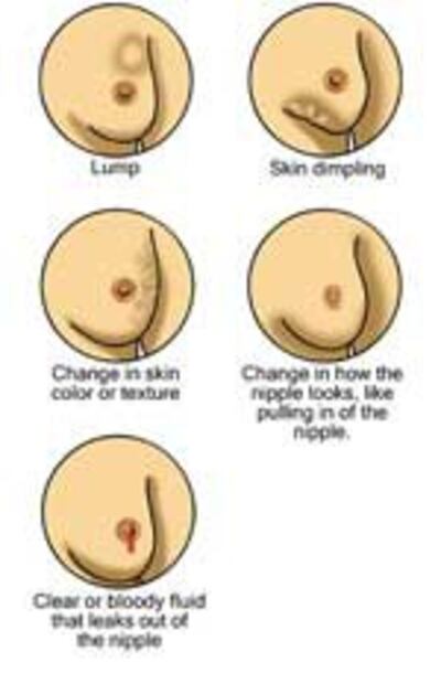 BreastCancer150.jpg