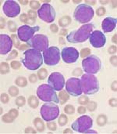 LeukemiaBachCau150.jpg