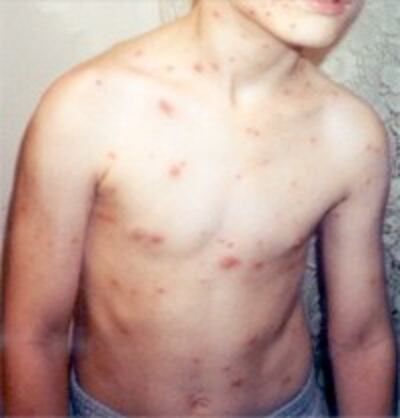 ChickenPox200.jpg