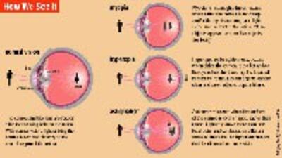 laserEyeSurgery200.jpg