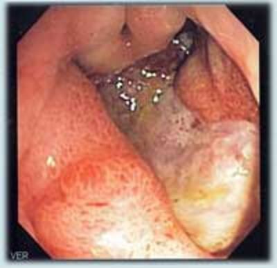 DeepGastricUlcer200.jpg