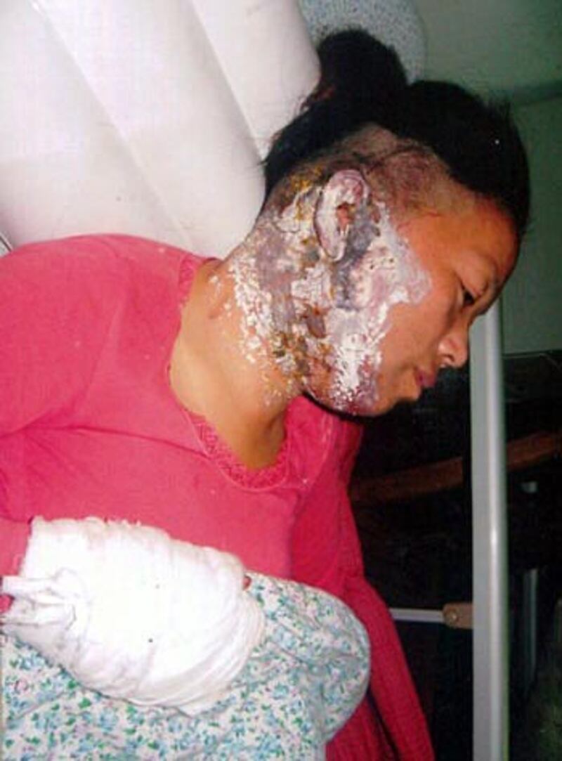 湖北省漢川市霍城村村民余丹明，5 年前因反抗強拆被嚴重燒傷。 (民生觀察劉飛躍提供) 