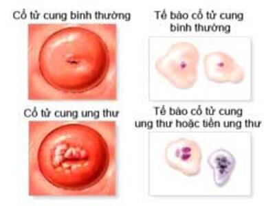 Cổ tử cung bình thường và cổ tử cung ung thư. Photo courtesy of healthline.com